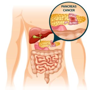 Cancer du pancréas