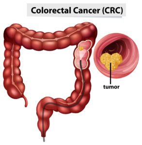 cancer colorectal